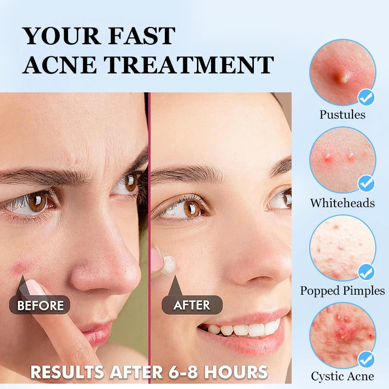 36 Count Acne Patches in 3 Colors for Face Hydrocolloid Patches with Acrylic by Wany Beauty